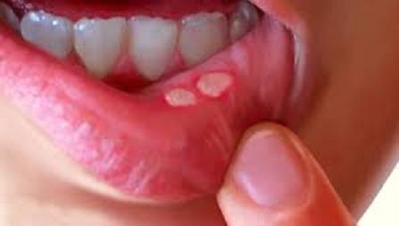 Úlcera en la boca